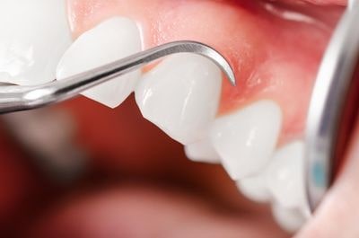 Как профессиональная чистка зубов может сэкономить от 70 000 ₽