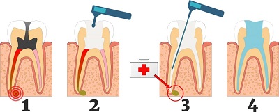 Хронический гранулирующий периодонтит в детской стоматологии: молочные зубы