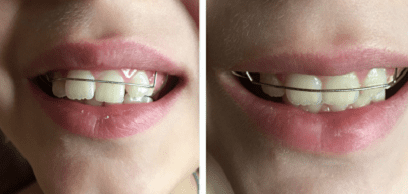 Пластинки на зубы: съемные и несъемные